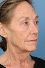 Face Lift/ Neck Lift