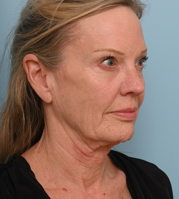 Face Lift/ Neck Lift