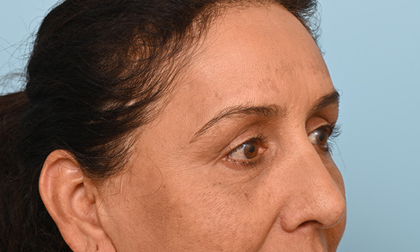Facial Fat Transfer