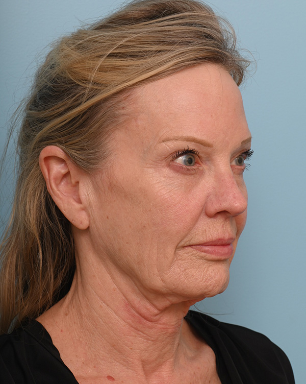 Facial Fat Transfer