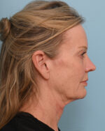 Facial Fat Transfer