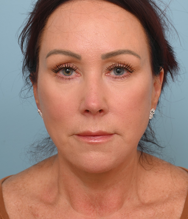 Face Lift/ Neck Lift