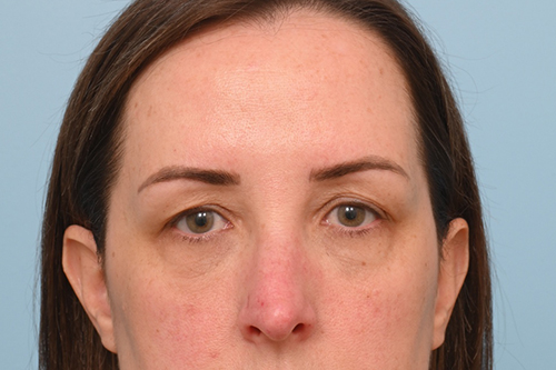 Eye Rejuvenation