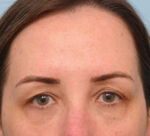 Brow Lift