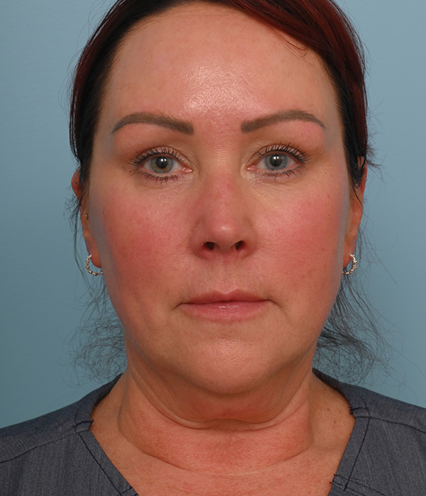 Face Lift/ Neck Lift