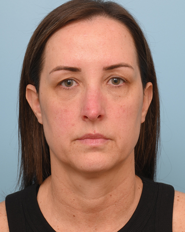 Facial Fat Transfer