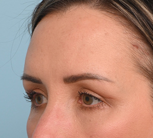 Brow Lift