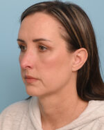 Facial Fat Transfer