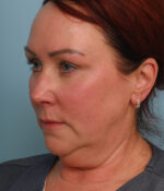 Face Lift/ Neck Lift
