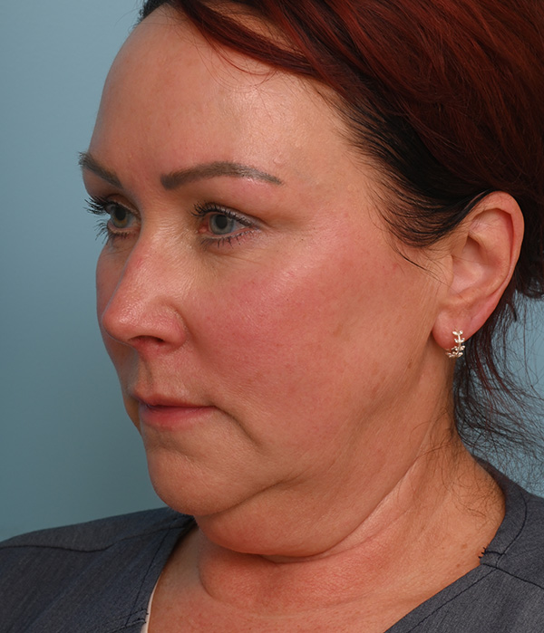 Face Lift/ Neck Lift