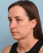 Facial Fat Transfer