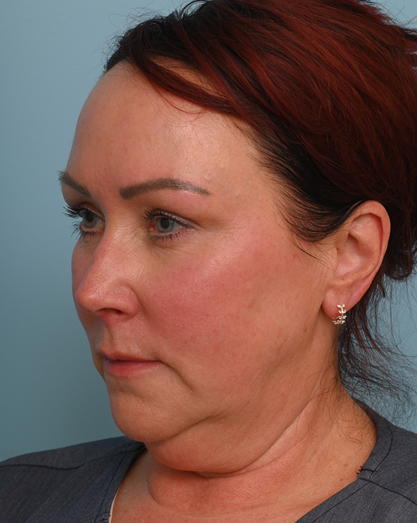 Facial Fat Transfer