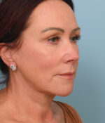 Face Lift/ Neck Lift