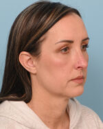 Facial Fat Transfer