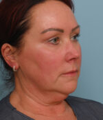 Face Lift/ Neck Lift