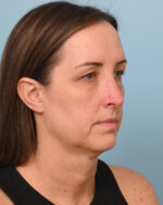 Facial Fat Transfer