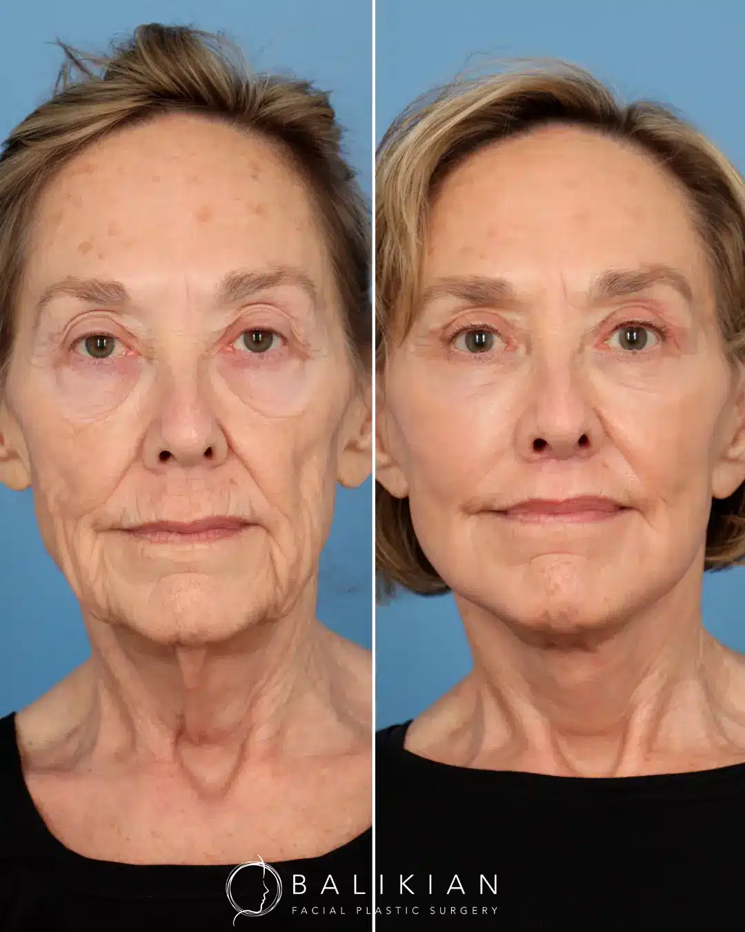 Dr. Balikian combines engineering and artistry to create beautiful results, like this one! He performed a the Comprehensive Artiste Lift – A preservation Deep Plane Facelift and Deep Vertical Necklift with Submandibular Gland Reduction, Temporal Lift, Upper Blepharoplasty, Lower Scarless Blepharoplasty, Deep Plane Subnasal Lip Lift, Facial Fat Transfer and C02 Laser.