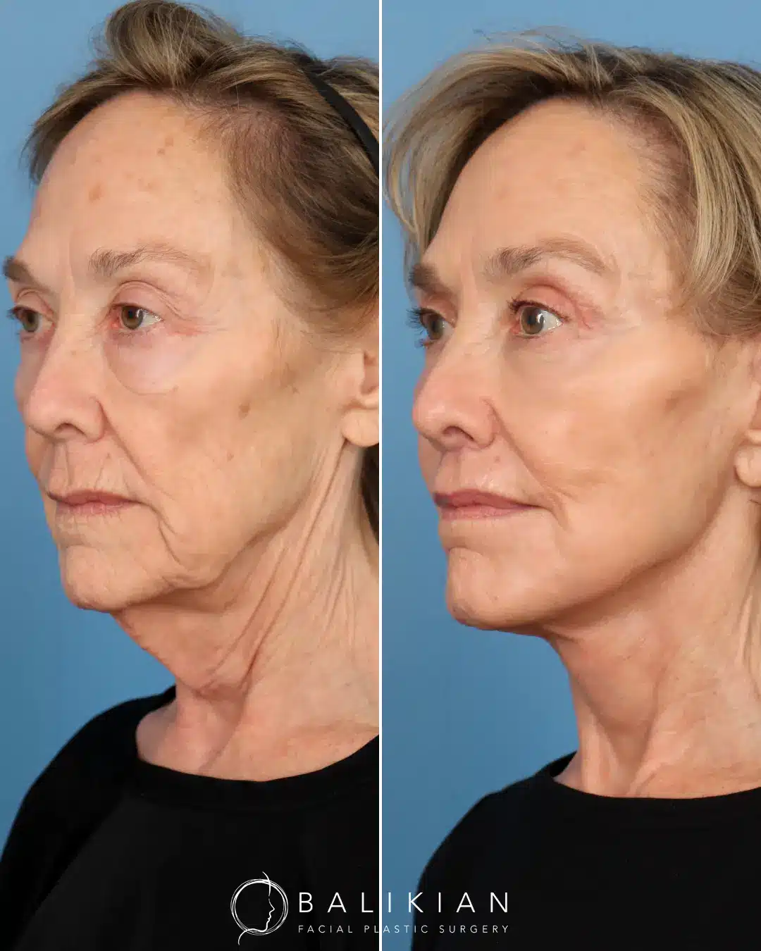 Dr. Balikian combines engineering and artistry to create beautiful results, like this one! He performed a the Comprehensive Artiste Lift – A preservation Deep Plane Facelift and Deep Vertical Necklift with Submandibular Gland Reduction, Temporal Lift, Upper Blepharoplasty, Lower Scarless Blepharoplasty, Deep Plane Subnasal Lip Lift, Facial Fat Transfer and C02 Laser.