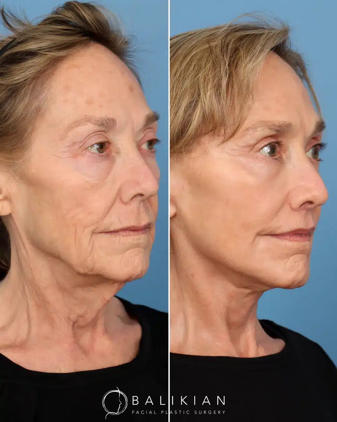 Dr. Balikian combines engineering and artistry to create beautiful results, like this one! He performed a the Comprehensive Artiste Lift – A preservation Deep Plane Facelift and Deep Vertical Necklift with Submandibular Gland Reduction, Temporal Lift, Upper Blepharoplasty, Lower Scarless Blepharoplasty, Deep Plane Subnasal Lip Lift, Facial Fat Transfer and C02 Laser.