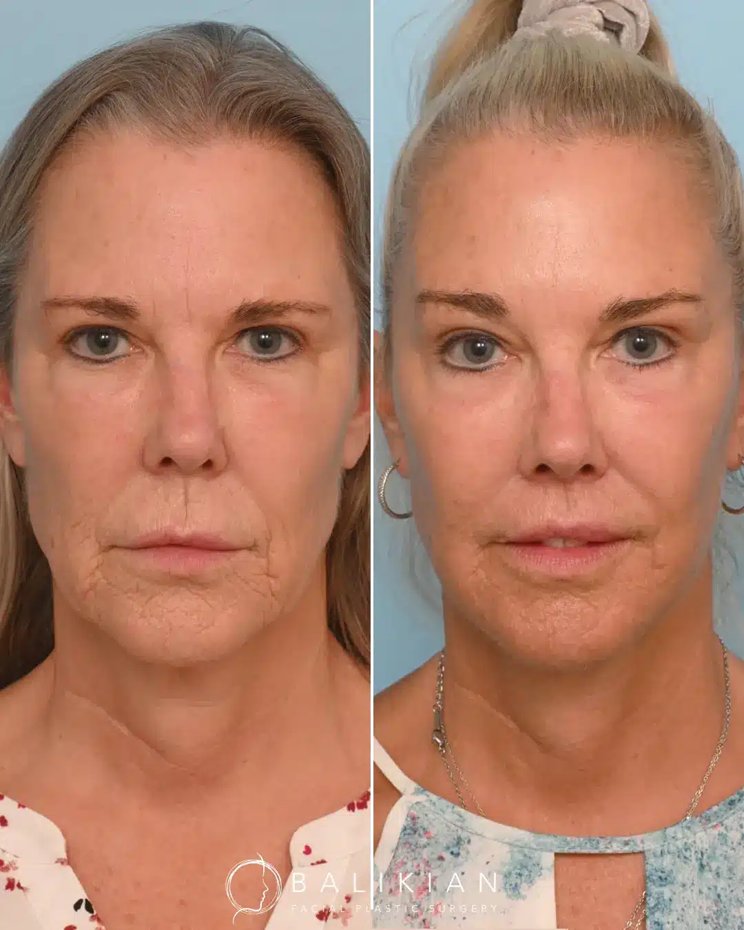 This patient came in wanting a sharper jawline with a natural, athletic appearance. To achieve this, Dr. Balikian performed a Deep Plane Face Lift with Vertical Deep Necklift, Perioral CO2 Laser and Fat Transfer to Partial Face.