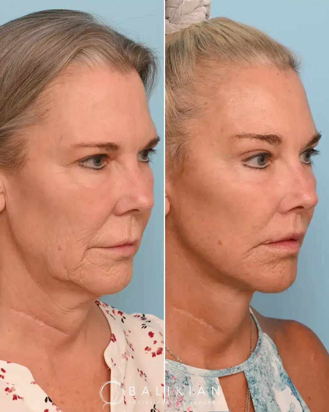 This patient came in wanting a sharper jawline with a natural, athletic appearance. To achieve this, Dr. Balikian performed a Deep Plane Face Lift with Vertical Deep Necklift, Perioral CO2 Laser and Fat Transfer to Partial Face.