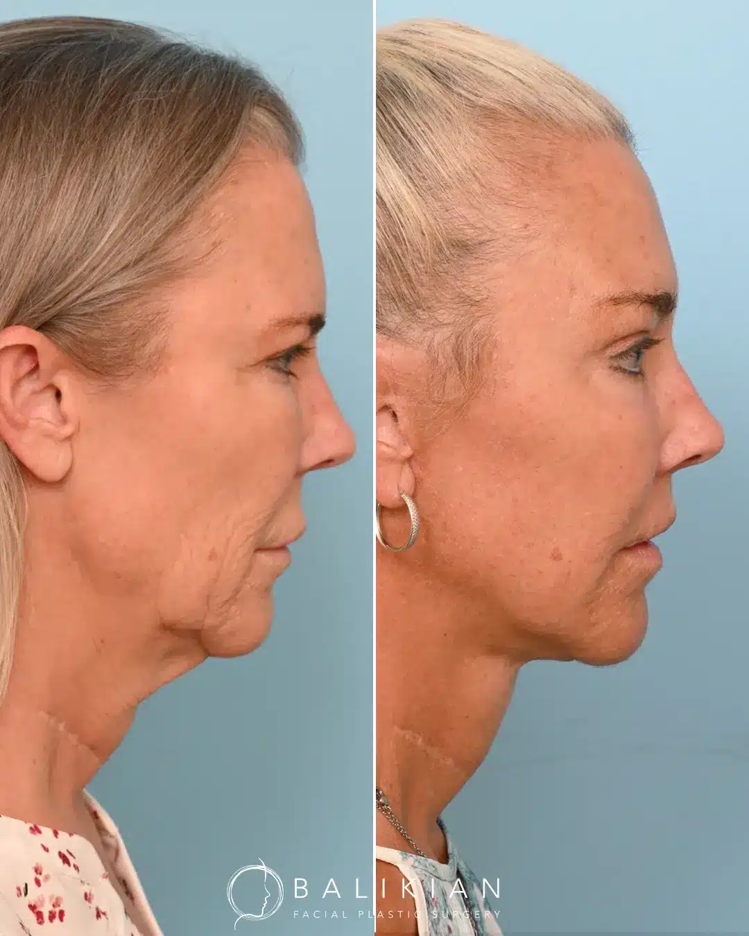 This patient came in wanting a sharper jawline with a natural, athletic appearance. To achieve this, Dr. Balikian performed a Deep Plane Face Lift with Vertical Deep Necklift, Perioral CO2 Laser and Fat Transfer to Partial Face.