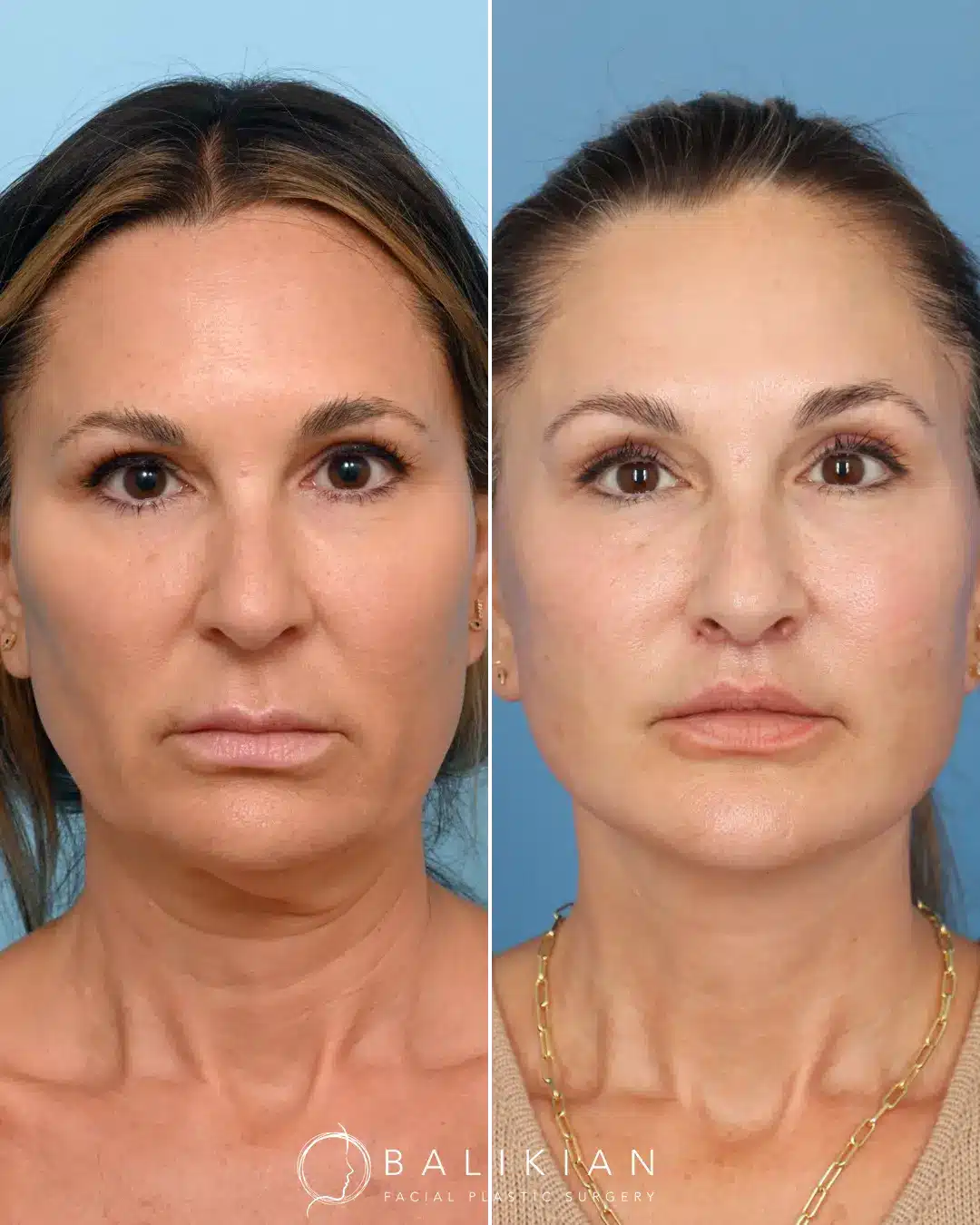 This patient came in still wanting to look like her natural self, only brighter and younger! Dr. Balikian performed a Deep Plane Facelift and Neck Lift, Temporal Browlift, Subnasal Lip Lift and Partial Fat Transfer.