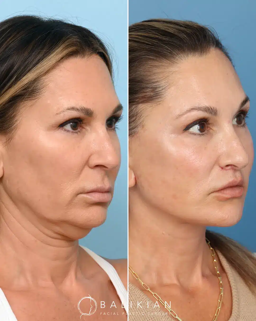 This patient came in still wanting to look like her natural self, only brighter and younger! Dr. Balikian performed a Deep Plane Facelift and Neck Lift, Temporal Browlift, Subnasal Lip Lift and Partial Fat Transfer.