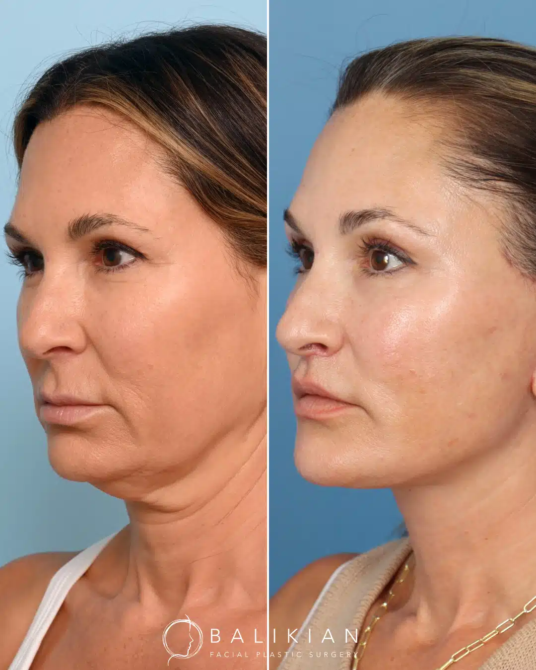This patient came in still wanting to look like her natural self, only brighter and younger! Dr. Balikian performed a Deep Plane Facelift and Neck Lift, Temporal Browlift, Subnasal Lip Lift and Partial Fat Transfer.