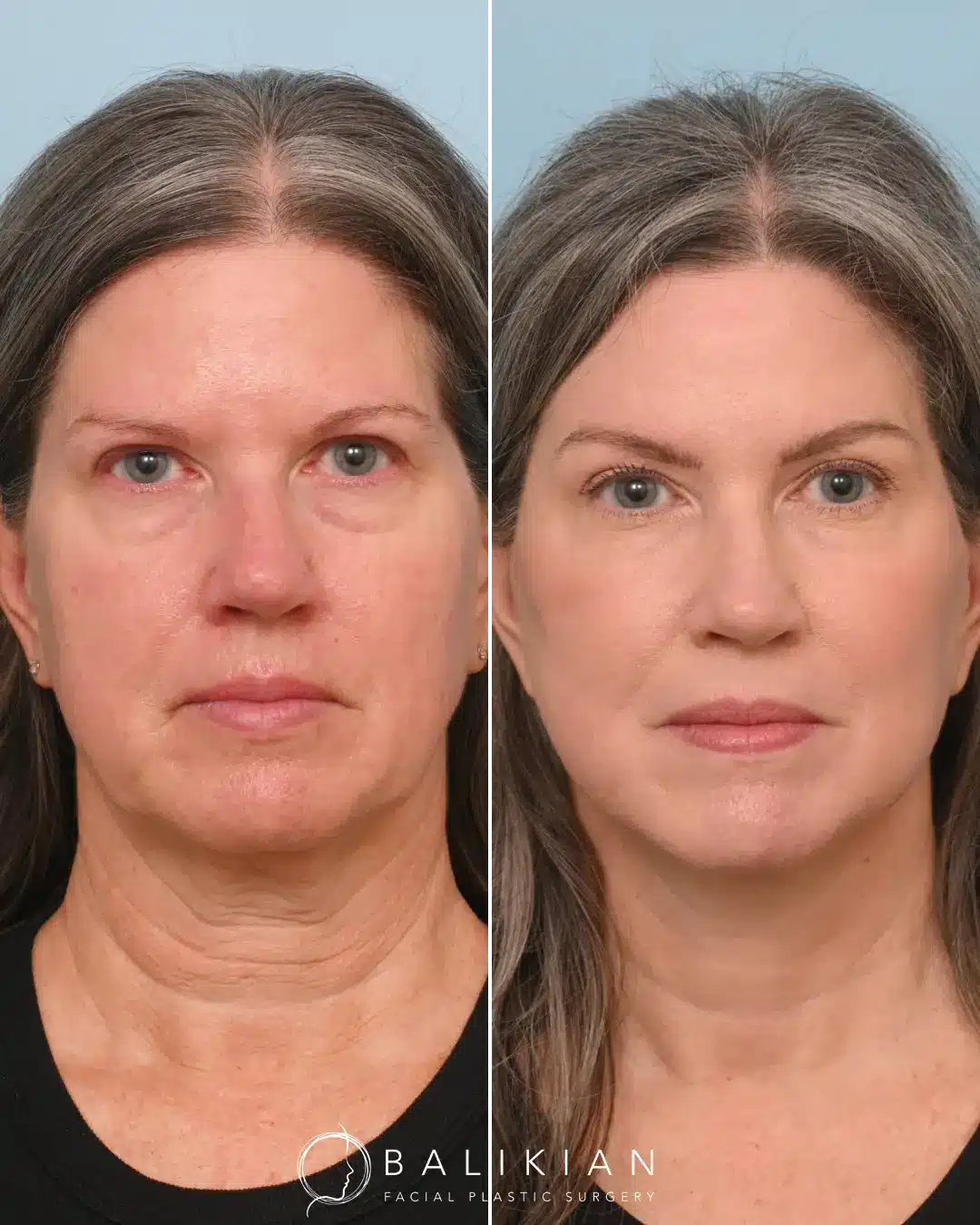 As a facelift specialist, Dr. Balikian’s goal is to help you embrace a refreshed, youthful version of yourself. Every procedure is tailored to your unique facial structure, ensuring natural and harmonious results. Trust the journey to rejuvenation and watch as your inner beauty shines through. To achieve this beautiful transformation, Dr. Balikian performed his comprehensive Artiste Lift, which included a preservation deep plane facelift, deep vertical neck lift, 4-point brow lift, and full face fat transfer. This customized approach highlights Dr. Balikian’s commitment to natural results and meticulous attention to detail, helping patients look as vibrant as they feel.