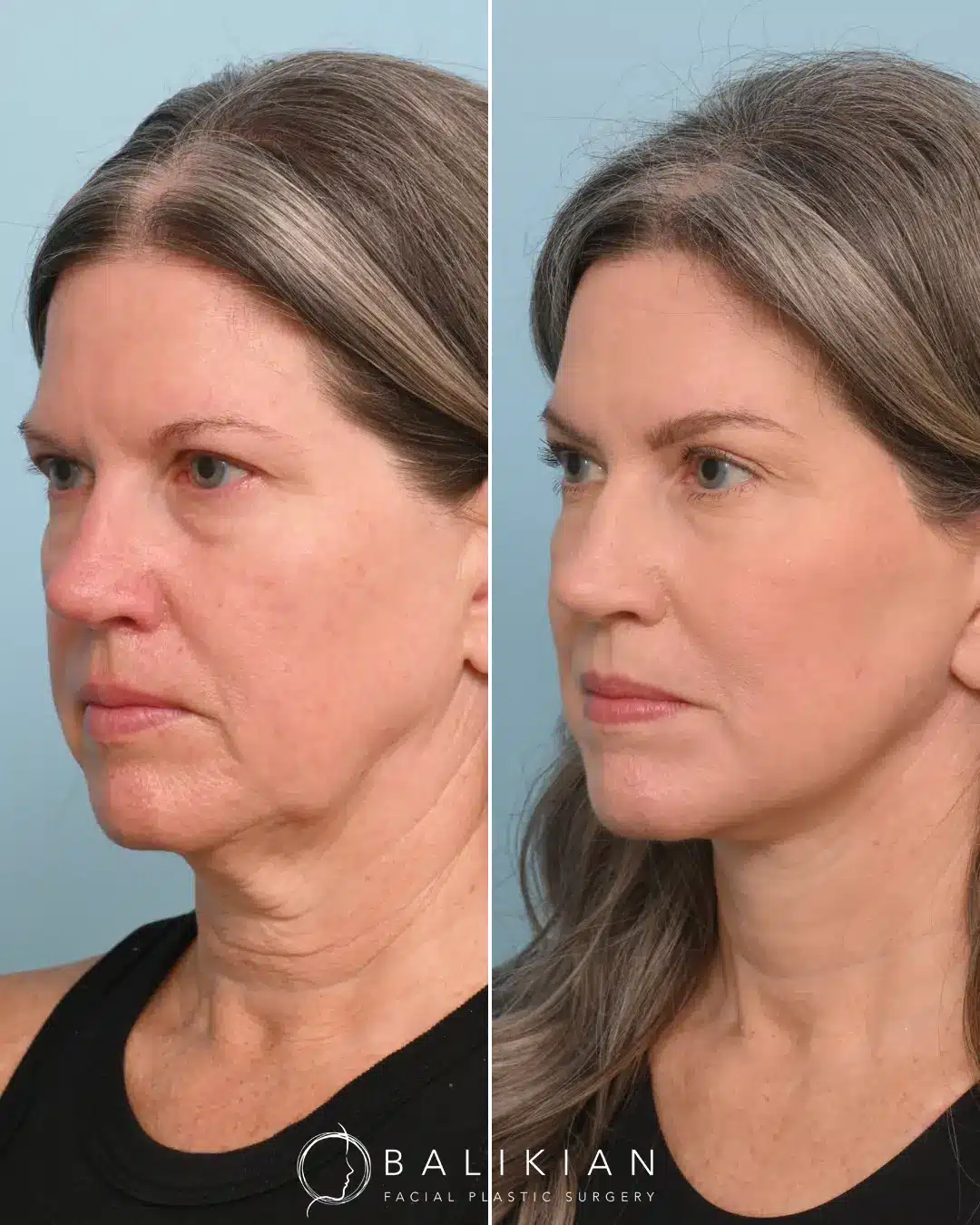 As a facelift specialist, Dr. Balikian’s goal is to help you embrace a refreshed, youthful version of yourself. Every procedure is tailored to your unique facial structure, ensuring natural and harmonious results. Trust the journey to rejuvenation and watch as your inner beauty shines through. To achieve this beautiful transformation, Dr. Balikian performed his comprehensive Artiste Lift, which included a preservation deep plane facelift, deep vertical neck lift, 4-point brow lift, and full face fat transfer. This customized approach highlights Dr. Balikian’s commitment to natural results and meticulous attention to detail, helping patients look as vibrant as they feel.