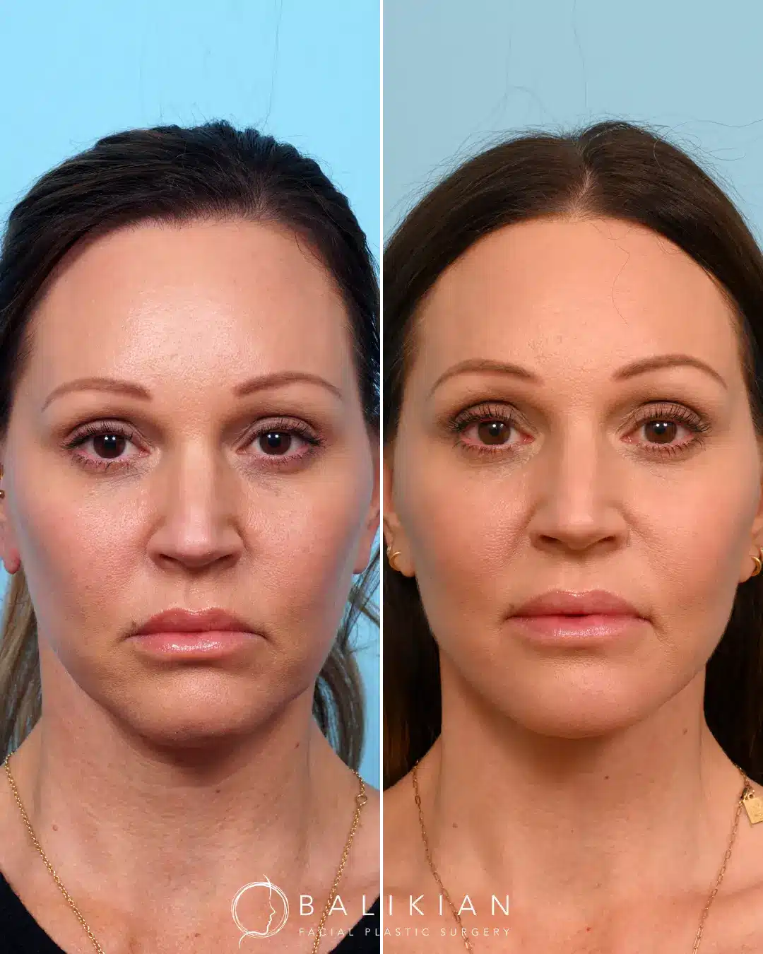 This patient had a previous facelift from another surgeon but was wishing for more improvement in her neck. Dr. Balikian performed a revision necklift that focused on contouring the structures deep in the neck. This way of performing a necklift is different than how the majority of plastic surgeon work on the neck. Instead of just liposuction and platysmaplasty (like most surgeons perform), Dr. Balikian can remove the deeper layers of fat that can’t be liposuctioned (sub-platysmal fat), and contour the deep structures of the neck including muscles (digastric removal) and glands. The result is a sharp, beautiful neckline, with the excess tissues removed. Not all facelifts are done the same way. Dr. Balikian uses the most advanced techniques.