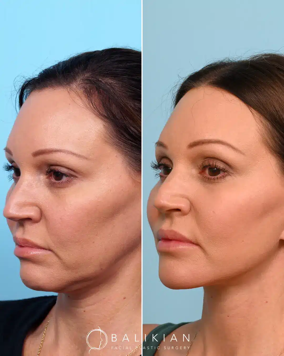 This patient had a previous facelift from another surgeon but was wishing for more improvement in her neck. Dr. Balikian performed a revision necklift that focused on contouring the structures deep in the neck. This way of performing a necklift is different than how the majority of plastic surgeon work on the neck. Instead of just liposuction and platysmaplasty (like most surgeons perform), Dr. Balikian can remove the deeper layers of fat that can’t be liposuctioned (sub-platysmal fat), and contour the deep structures of the neck including muscles (digastric removal) and glands. The result is a sharp, beautiful neckline, with the excess tissues removed. Not all facelifts are done the same way. Dr. Balikian uses the most advanced techniques.