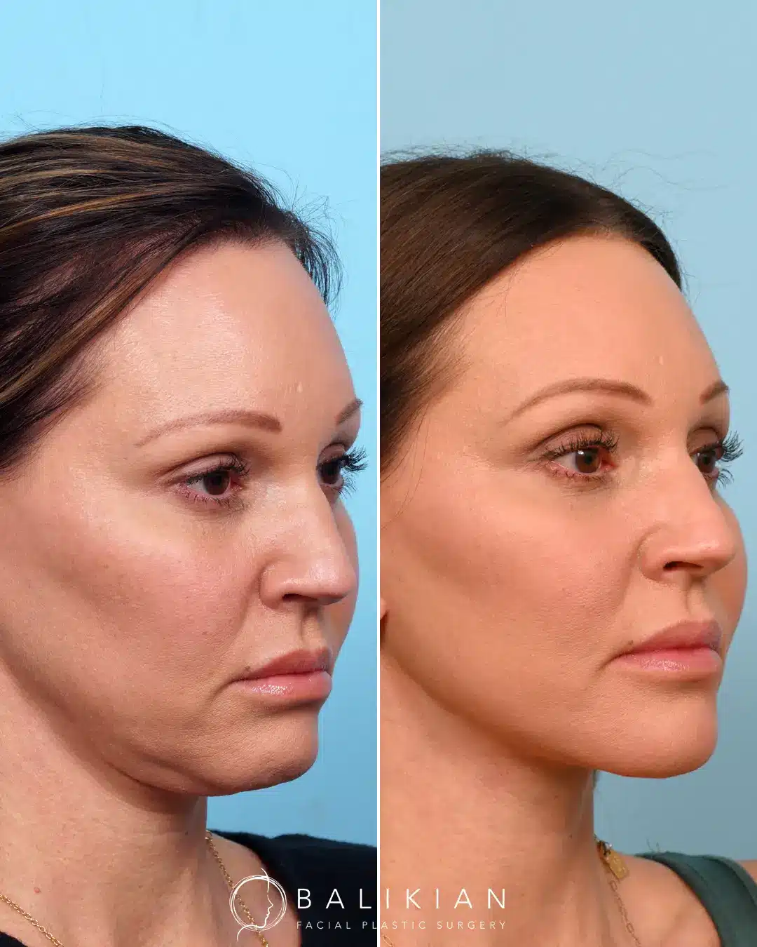 This patient had a previous facelift from another surgeon but was wishing for more improvement in her neck. Dr. Balikian performed a revision necklift that focused on contouring the structures deep in the neck. This way of performing a necklift is different than how the majority of plastic surgeon work on the neck. Instead of just liposuction and platysmaplasty (like most surgeons perform), Dr. Balikian can remove the deeper layers of fat that can’t be liposuctioned (sub-platysmal fat), and contour the deep structures of the neck including muscles (digastric removal) and glands. The result is a sharp, beautiful neckline, with the excess tissues removed. Not all facelifts are done the same way. Dr. Balikian uses the most advanced techniques.