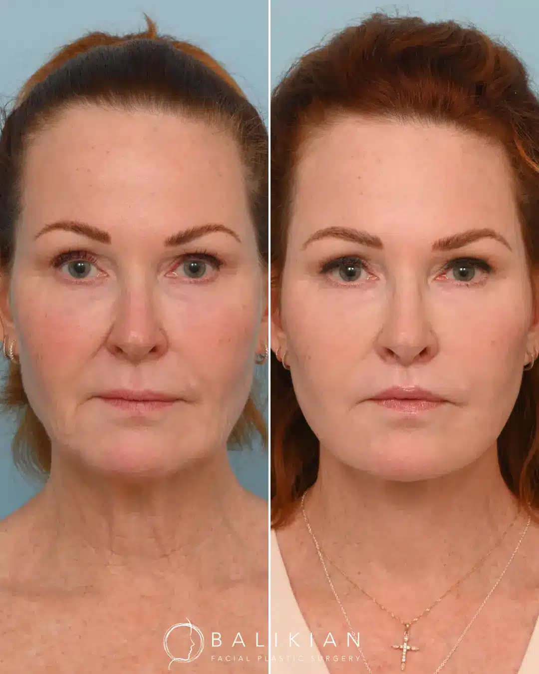 Who wants a snatched jawline! This patient came to us bothered by her jowls and just wanted them lifted to redefine her jawline. She is a perfect example of how Dr. Balikian’s method of a deep plane facelift and deep neck lift can unveil your natural beauty without looking like a different person. She has such natural beauty to her face that combining an extended deep plane face and neck lift with conservative fat transfer and targeted laser resurfacing, unveiled those beautiful features without creating a done look. That is the purpose of properly done full facial rejuvenation; not to create something new, but to unveil the beauty within.