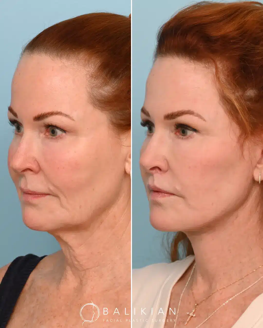 Who wants a snatched jawline! This patient came to us bothered by her jowls and just wanted them lifted to redefine her jawline. She is a perfect example of how Dr. Balikian’s method of a deep plane facelift and deep neck lift can unveil your natural beauty without looking like a different person. She has such natural beauty to her face that combining an extended deep plane face and neck lift with conservative fat transfer and targeted laser resurfacing, unveiled those beautiful features without creating a done look. That is the purpose of properly done full facial rejuvenation; not to create something new, but to unveil the beauty within.