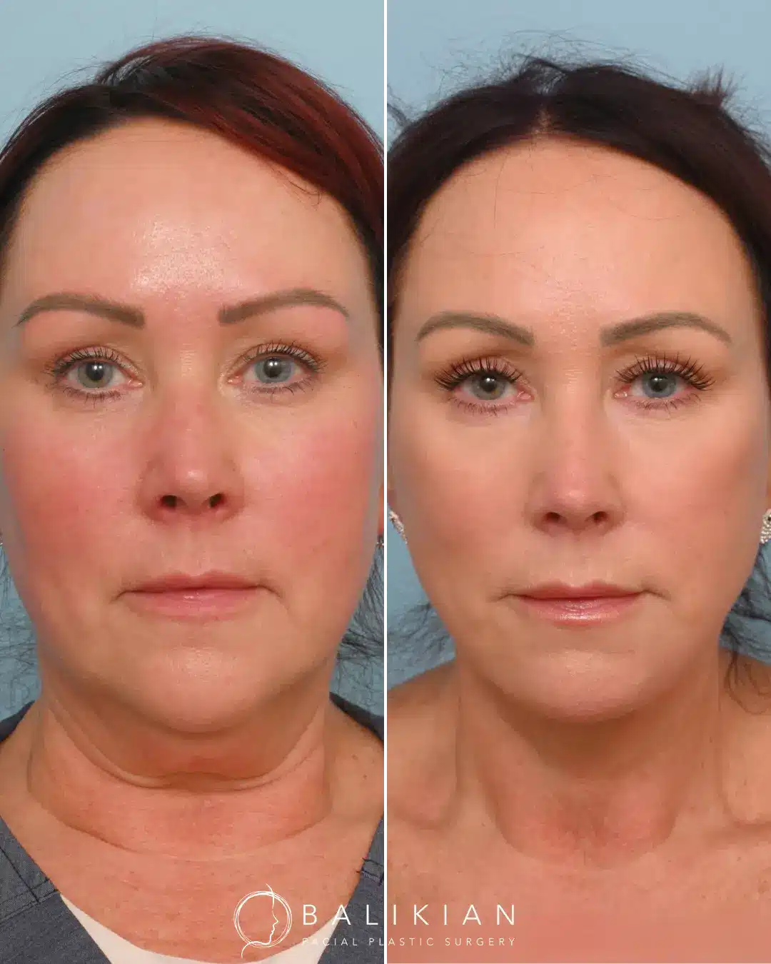 Dr. Balikian preformed his signature Comprehensive Artiste Lift which entails a Preservation Deep Plane Facelift, Deep Vertical Neck Lift, Facial Fat Transfer & CO2 Laser.