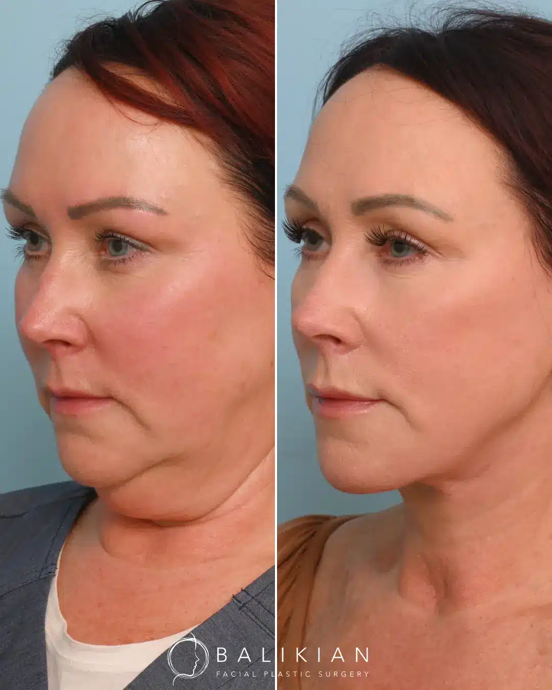 Dr. Balikian preformed his signature Comprehensive Artiste Lift which entails a Preservation Deep Plane Facelift, Deep Vertical Neck Lift, Facial Fat Transfer & CO2 Laser.
