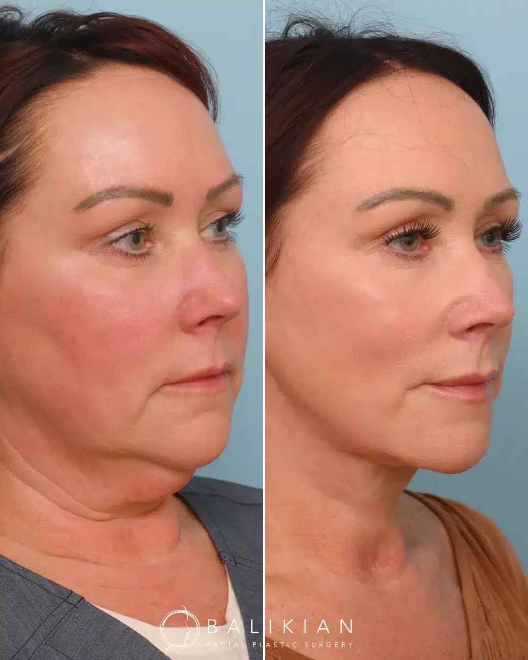 Dr. Balikian preformed his signature Comprehensive Artiste Lift which entails a Preservation Deep Plane Facelift, Deep Vertical Neck Lift, Facial Fat Transfer & CO2 Laser.