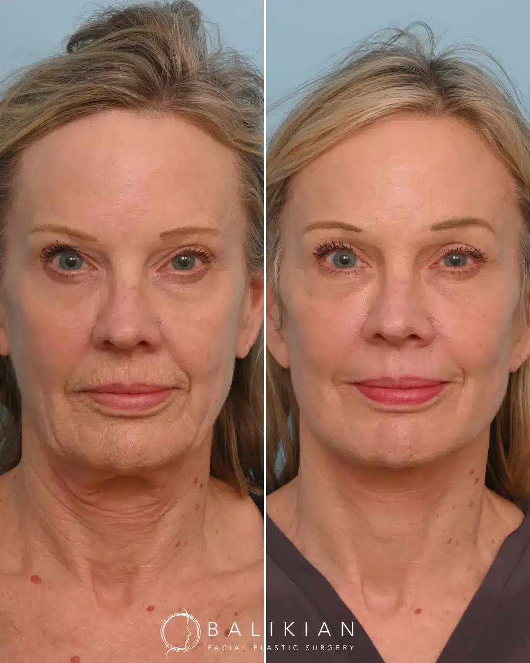 Our patient came to us seeking a natural, refreshed look—hoping to restore youthful contours to her cheeks and eliminate excess skin. The results of her transformation are truly remarkable. Her jawline is now beautifully defined, volume has been restored to her face, and her skin appears firmer and naturally rejuvenated. To achieve this outcome, Dr. Balikian performed a comprehensive facial rejuvenation procedure, which included a preservation deep plane facelift, deep vertical neck lift with submandibular gland reduction, temporal brow lift, bilateral upper blepharoplasty, full face fat transfer, and full face CO2 laser. Each component of this tailored approach worked in harmony to produce balanced, natural-looking results that reflect Dr. Balikian’s artistry and expertise.
