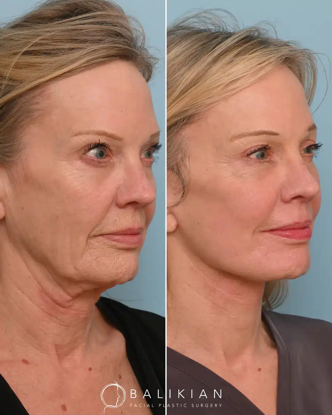 Our patient came to us seeking a natural, refreshed look—hoping to restore youthful contours to her cheeks and eliminate excess skin. The results of her transformation are truly remarkable. Her jawline is now beautifully defined, volume has been restored to her face, and her skin appears firmer and naturally rejuvenated. To achieve this outcome, Dr. Balikian performed a comprehensive facial rejuvenation procedure, which included a preservation deep plane facelift, deep vertical neck lift with submandibular gland reduction, temporal brow lift, bilateral upper blepharoplasty, full face fat transfer, and full face CO2 laser. Each component of this tailored approach worked in harmony to produce balanced, natural-looking results that reflect Dr. Balikian’s artistry and expertise.