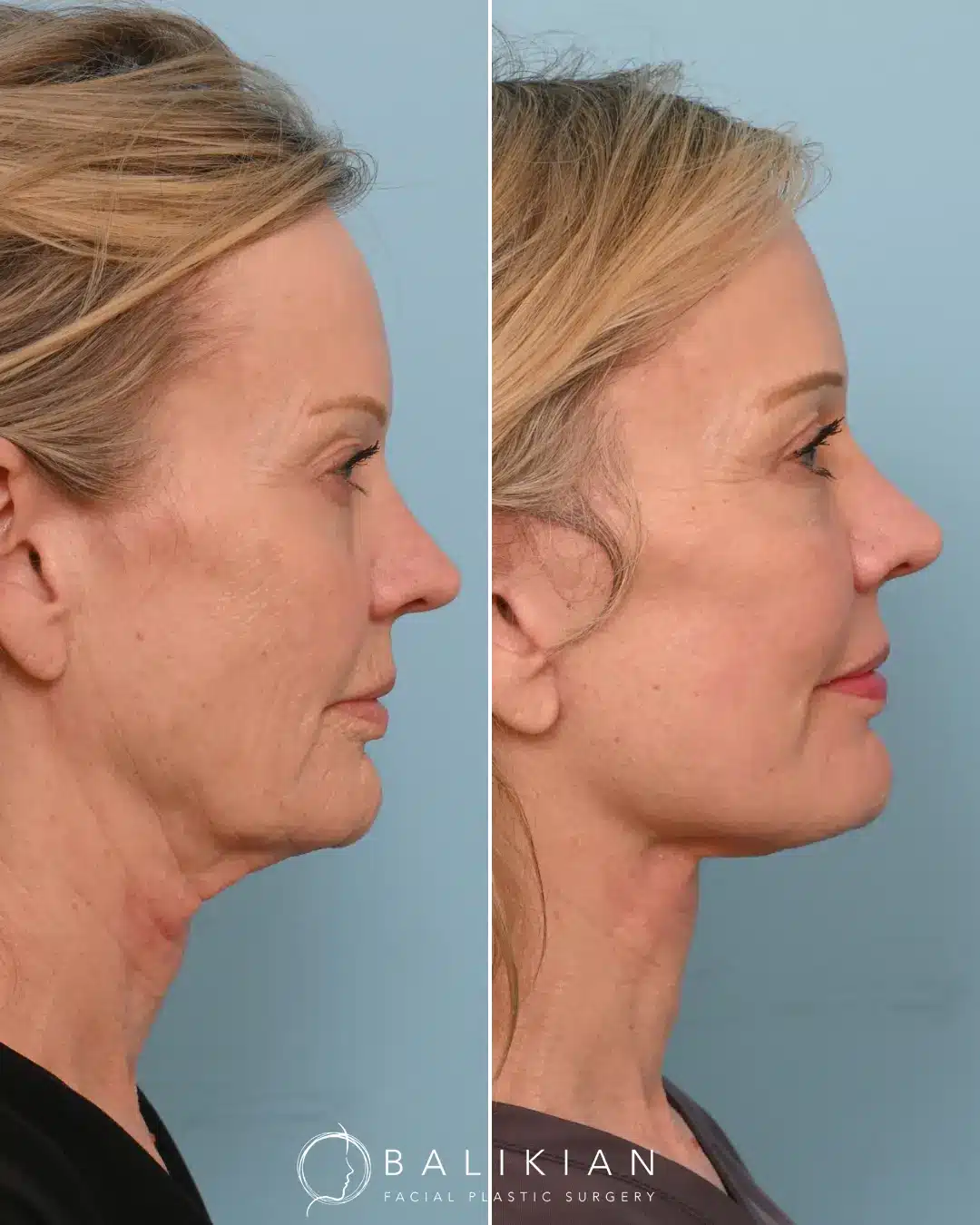 Our patient came to us seeking a natural, refreshed look—hoping to restore youthful contours to her cheeks and eliminate excess skin. The results of her transformation are truly remarkable. Her jawline is now beautifully defined, volume has been restored to her face, and her skin appears firmer and naturally rejuvenated. To achieve this outcome, Dr. Balikian performed a comprehensive facial rejuvenation procedure, which included a preservation deep plane facelift, deep vertical neck lift with submandibular gland reduction, temporal brow lift, bilateral upper blepharoplasty, full face fat transfer, and full face CO2 laser. Each component of this tailored approach worked in harmony to produce balanced, natural-looking results that reflect Dr. Balikian’s artistry and expertise.