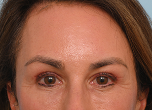 Brow Lift