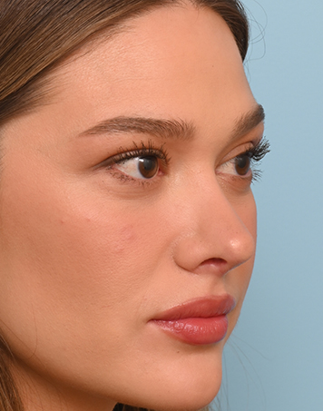 Rhinoplasty