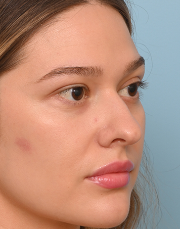 Rhinoplasty