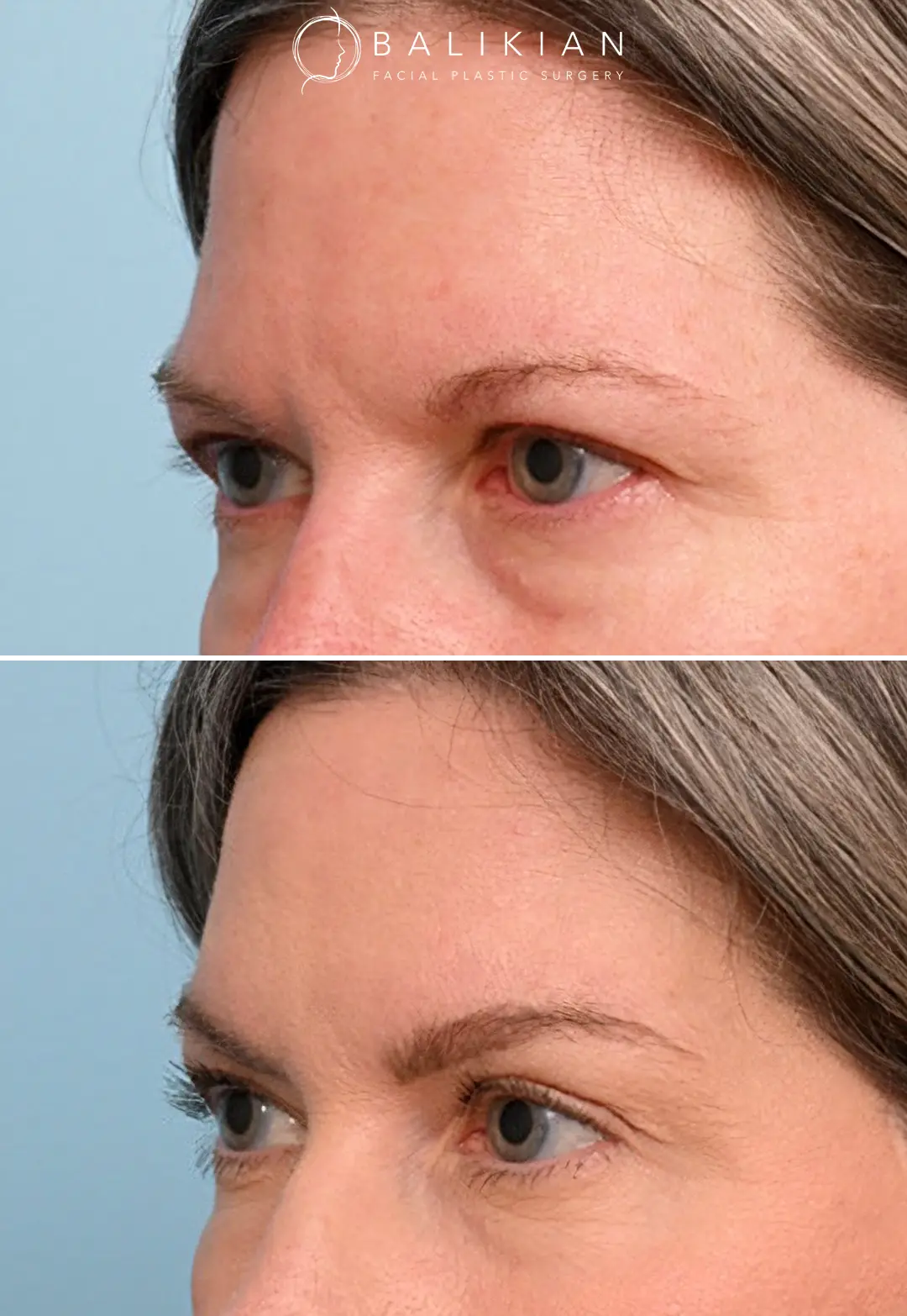 Brow lift before and after with clear improvement in upper facial balance.