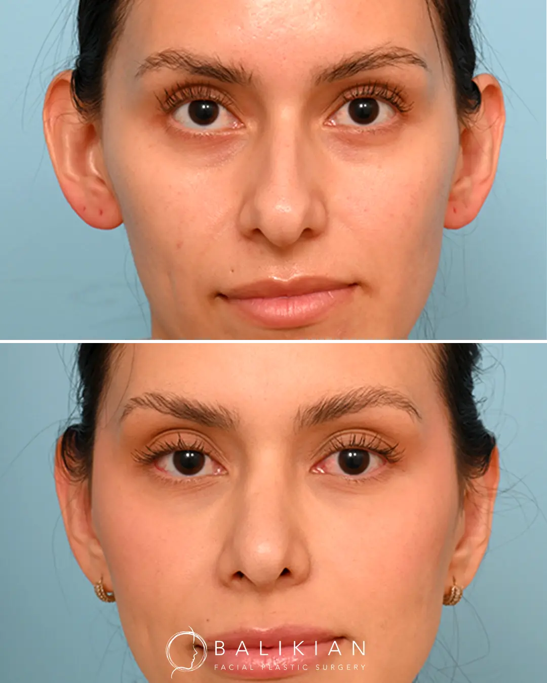 Before and after photo of a patient showing results of otoplasty surgery.