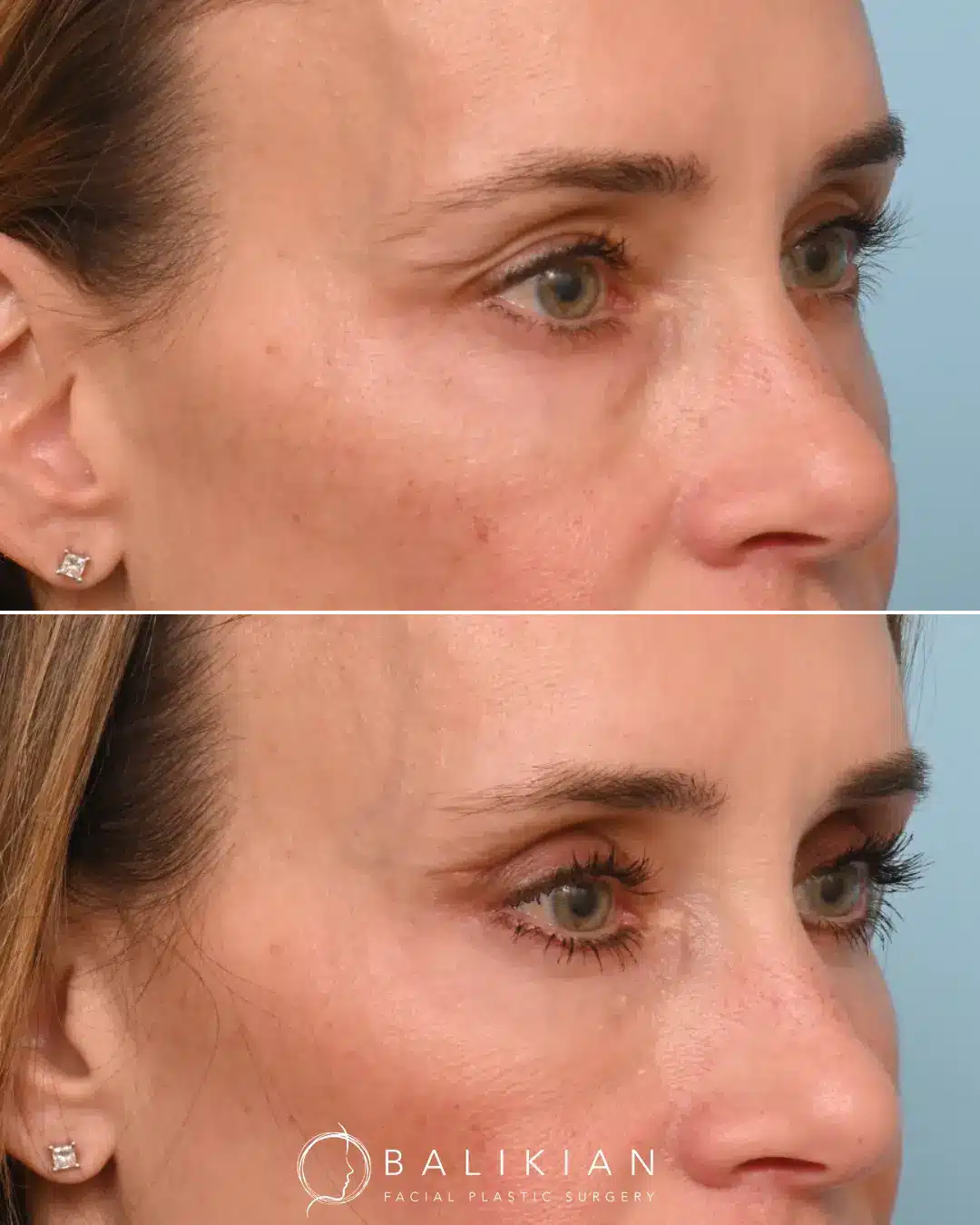 Eyelid enhancement before and after photo showing youthful correction