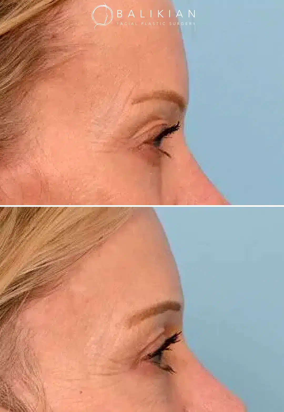 Side-by-side brow lift before and after with lifted brows and reduced hooding.