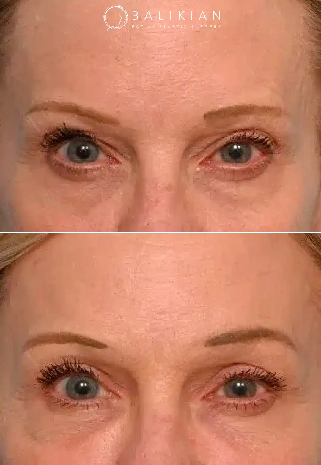 Forehead lift before and after close-up with reduced lines and elevated brow position.